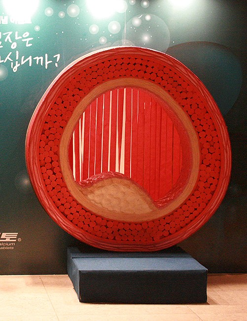 혈관 종결 수정